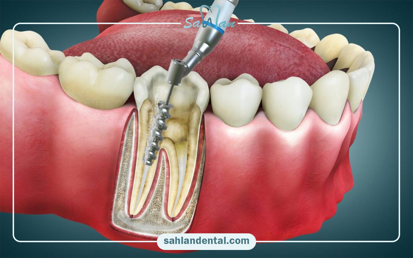 عصب کشی دندان چقدر طول می‌کشد