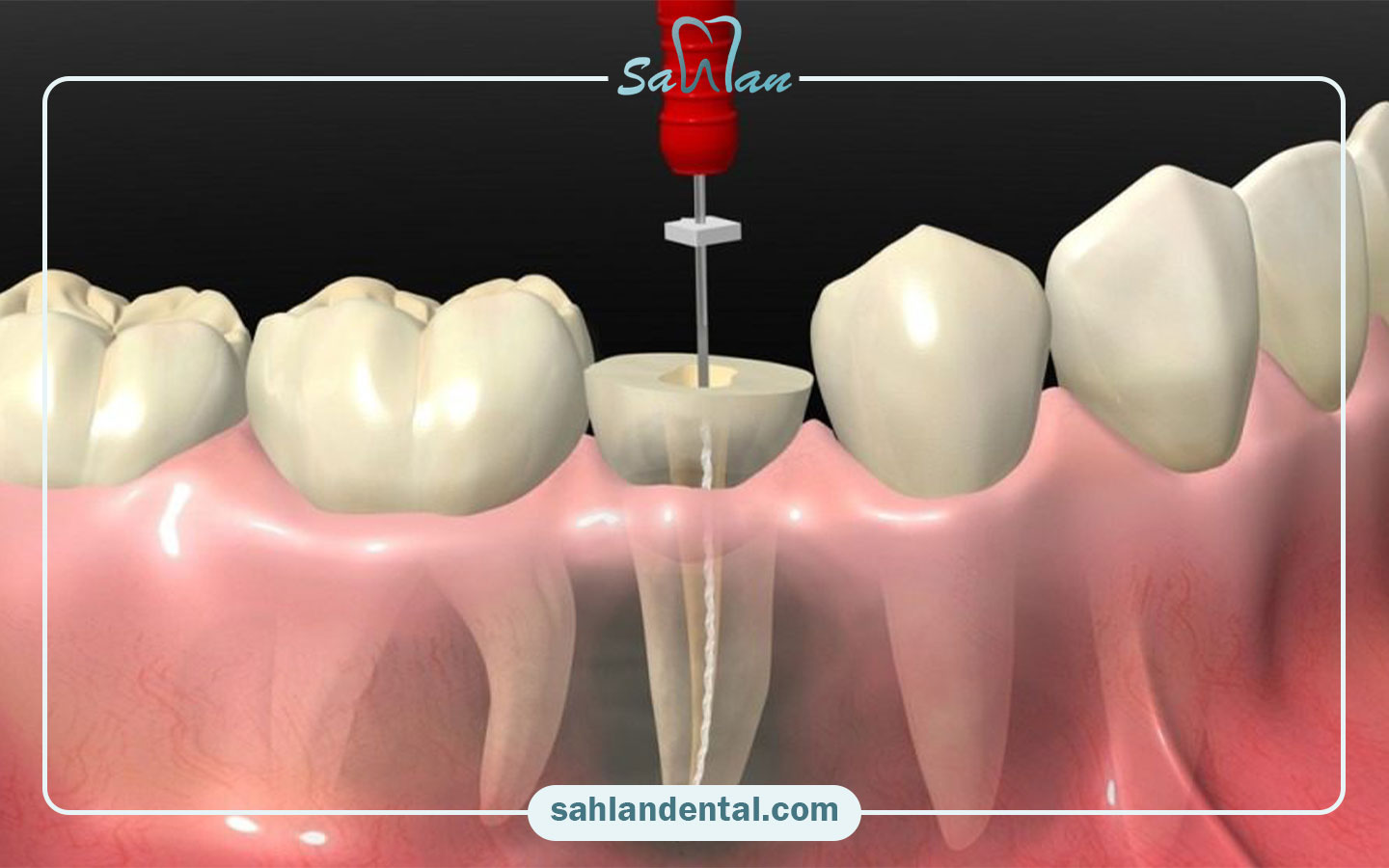 عصب کشی دندان چیست و چرا اهمیت دارد
