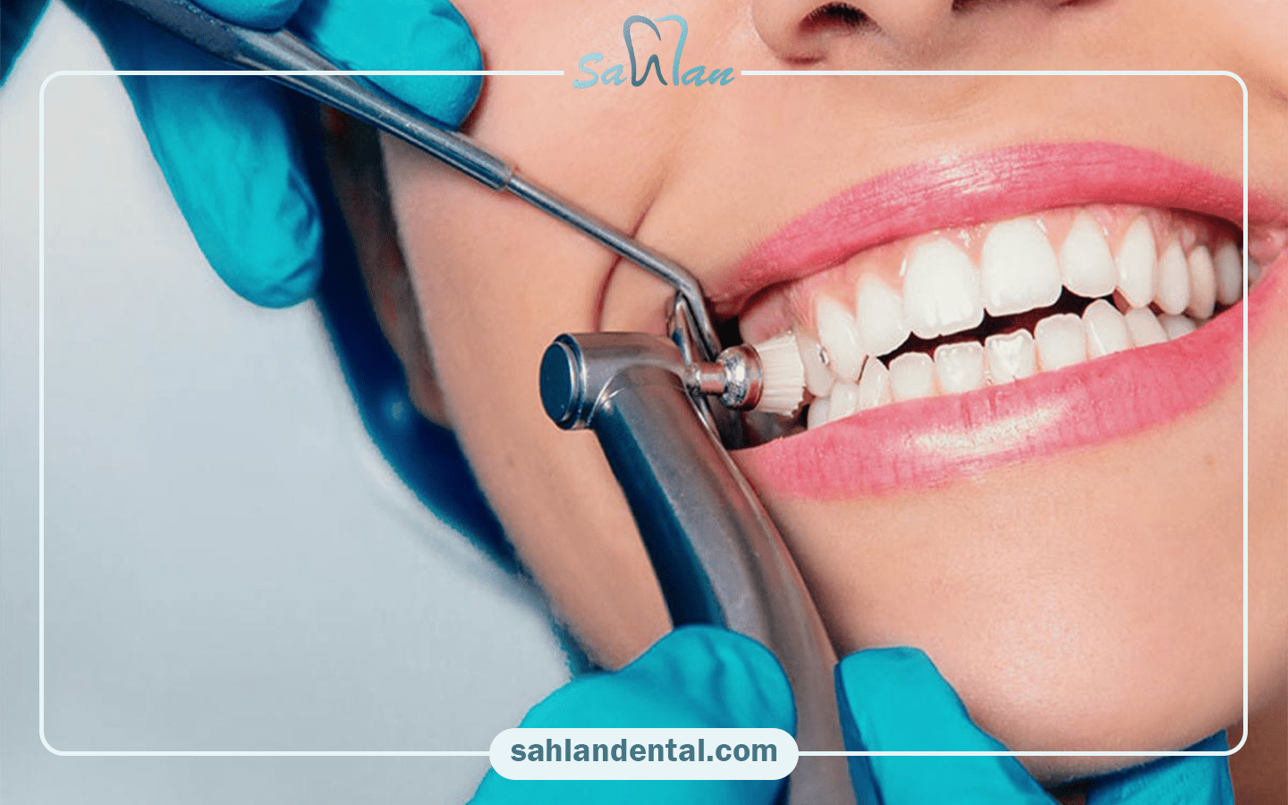 آیا پالیش دندان کامپوزیت شده حتما باید در دندانپزشکی انجام شود؟