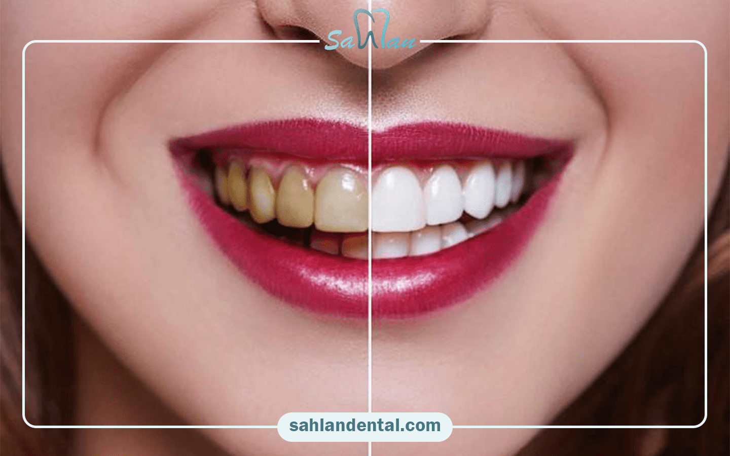 اهمیت پولیش کامپوزیت دندان