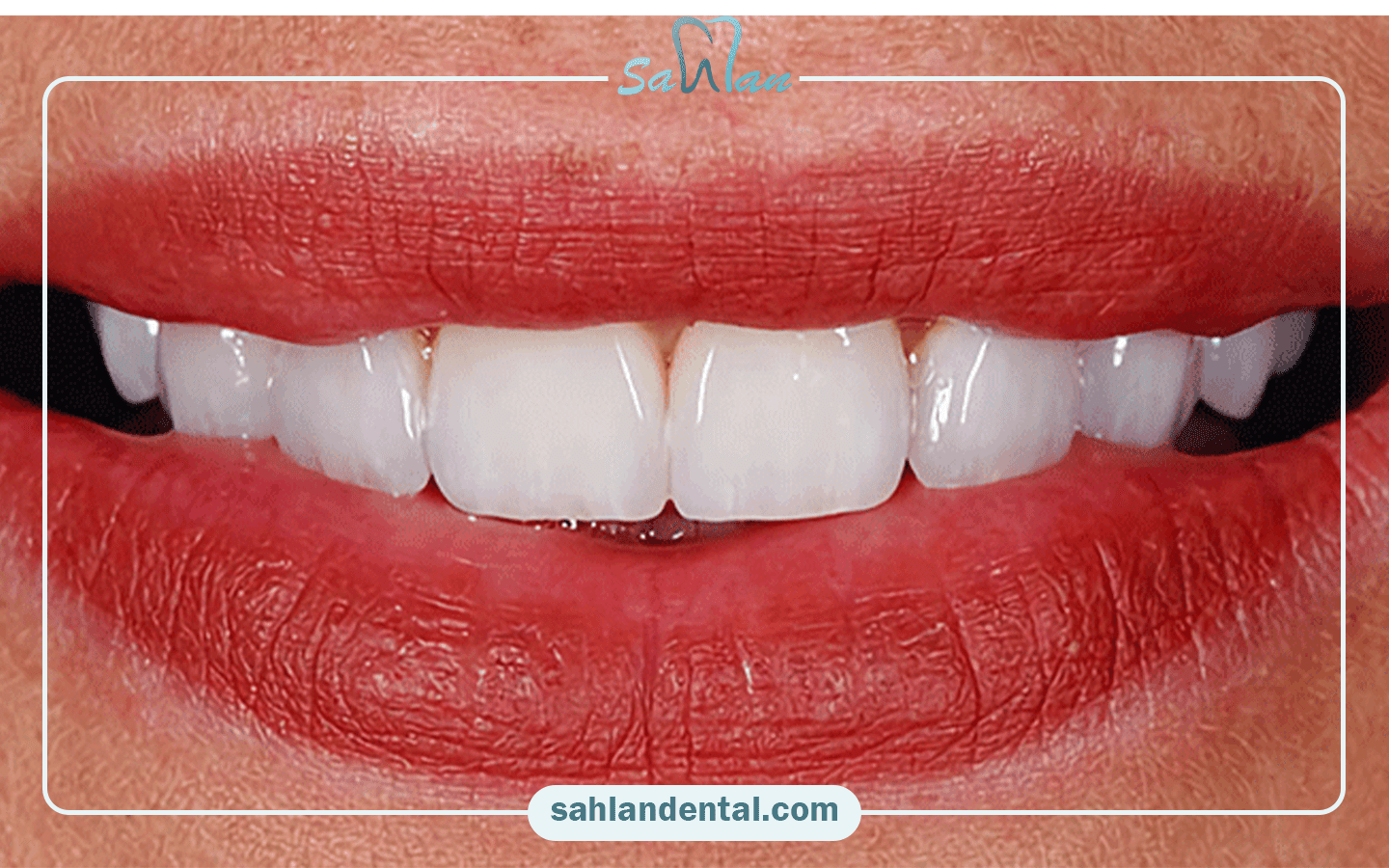 بعد از زرد شدن کامپوزیت چه باید کرد؟