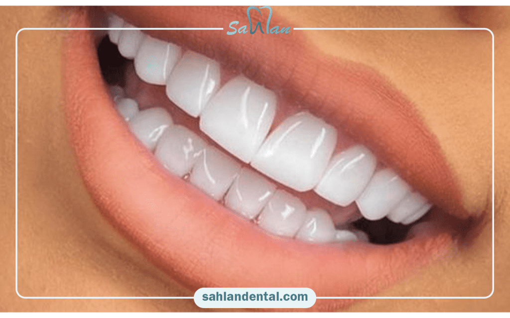 تغییر رنگ کامپوزیت دندان + راه های جلوگیری