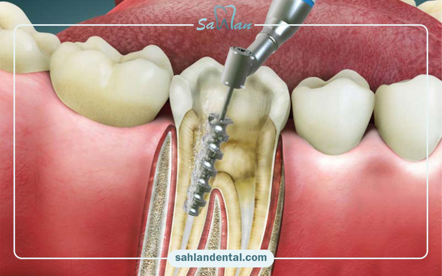 درمان ریشه دندان و عصب کشی