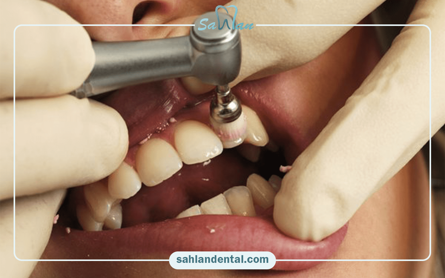 راه های پالیش دندان کامپوزیت شده در خانه