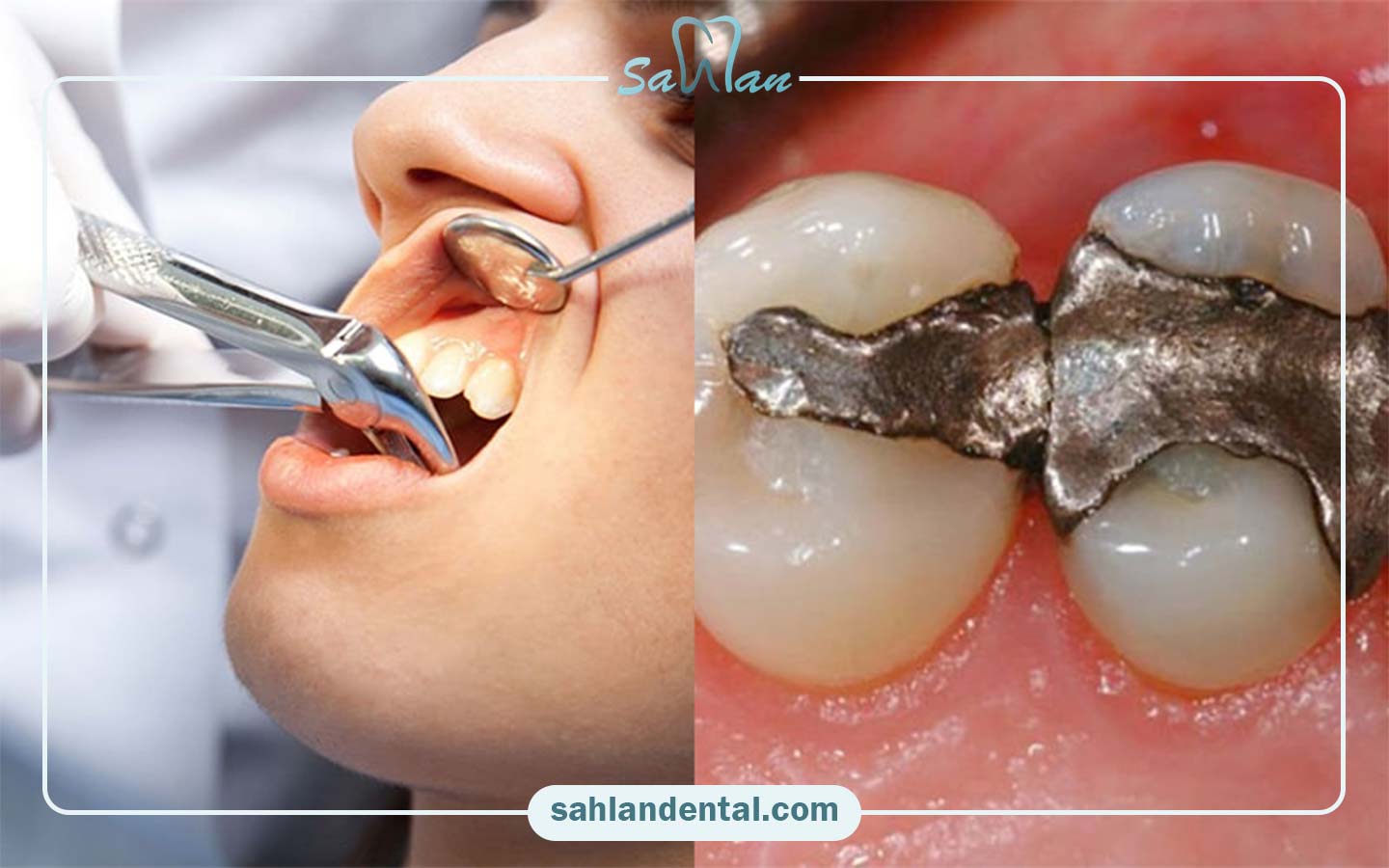 راه‌های پیشگیری از عوارض عصب‌کشی