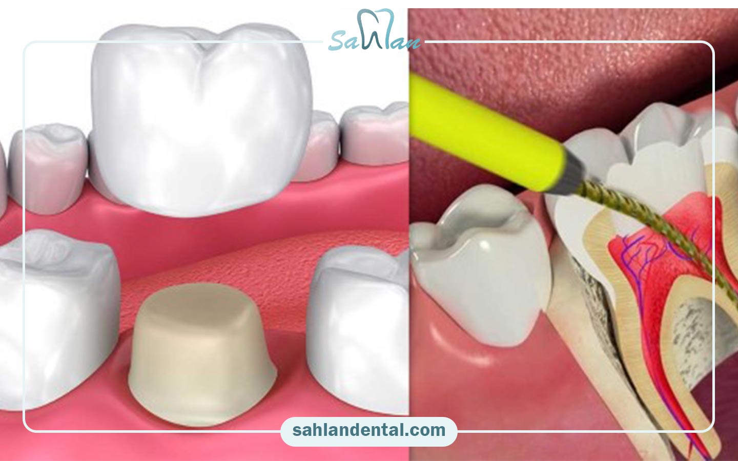 عصب کشی از روی روکش به چه شکلی انجام میشود؟