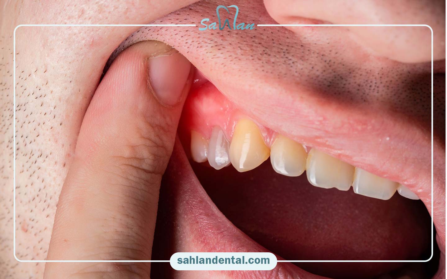 عصب کشی به موقع vs عدم درمان