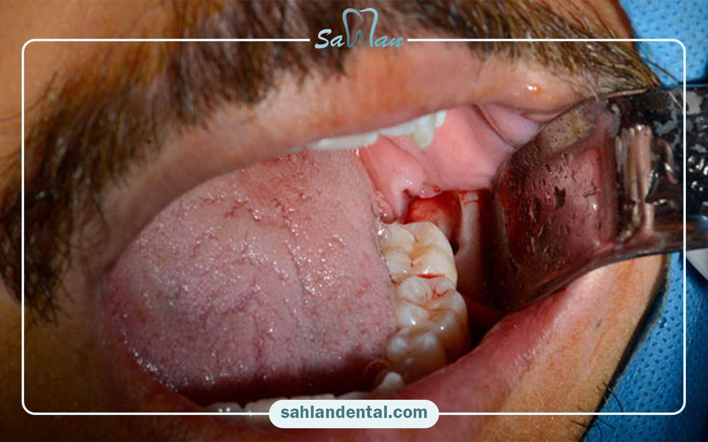 عصب‌کشی دندان عقل