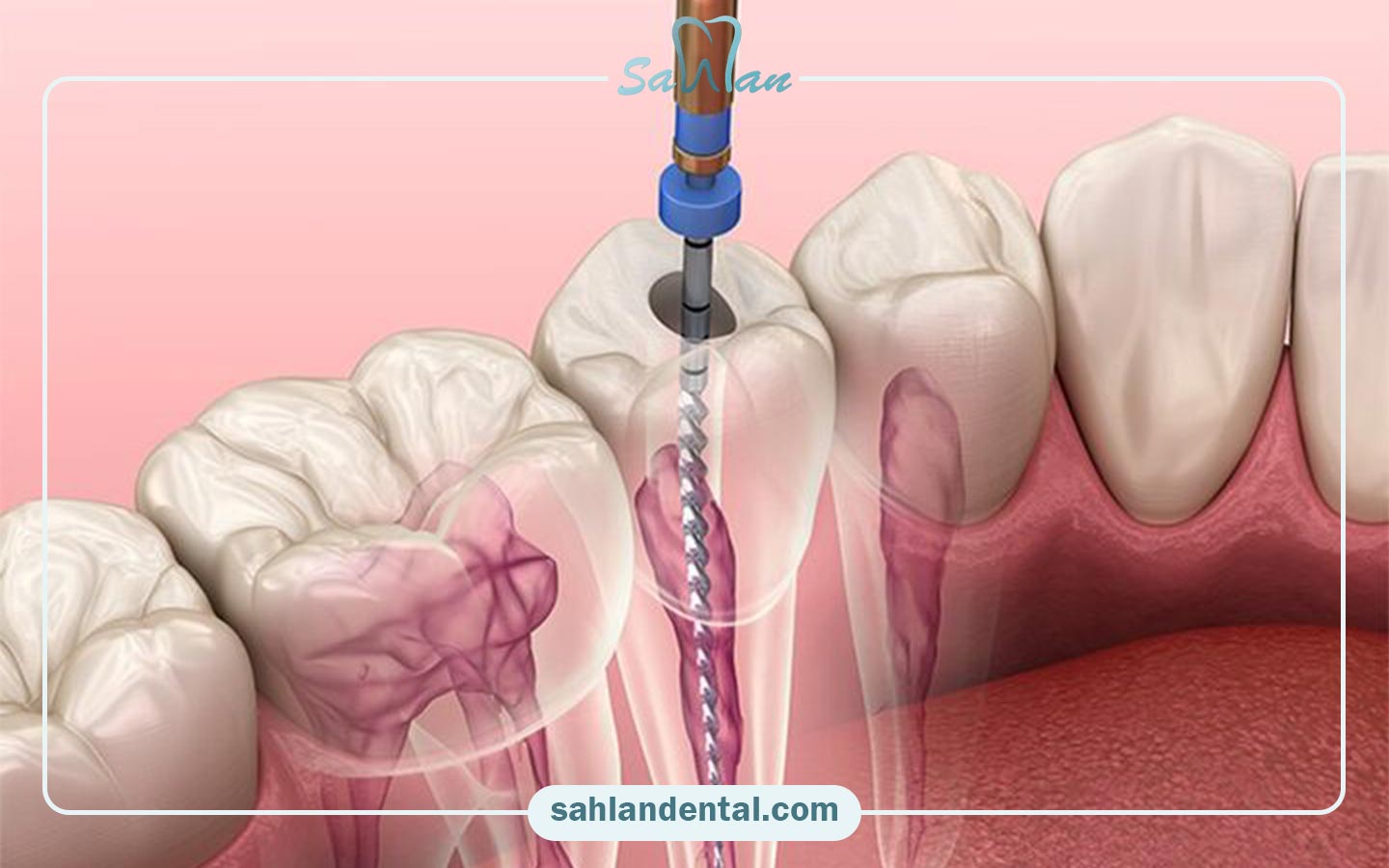 عفونت دندانی تا چه زمانی می‌تواند در دهان باقی بماند