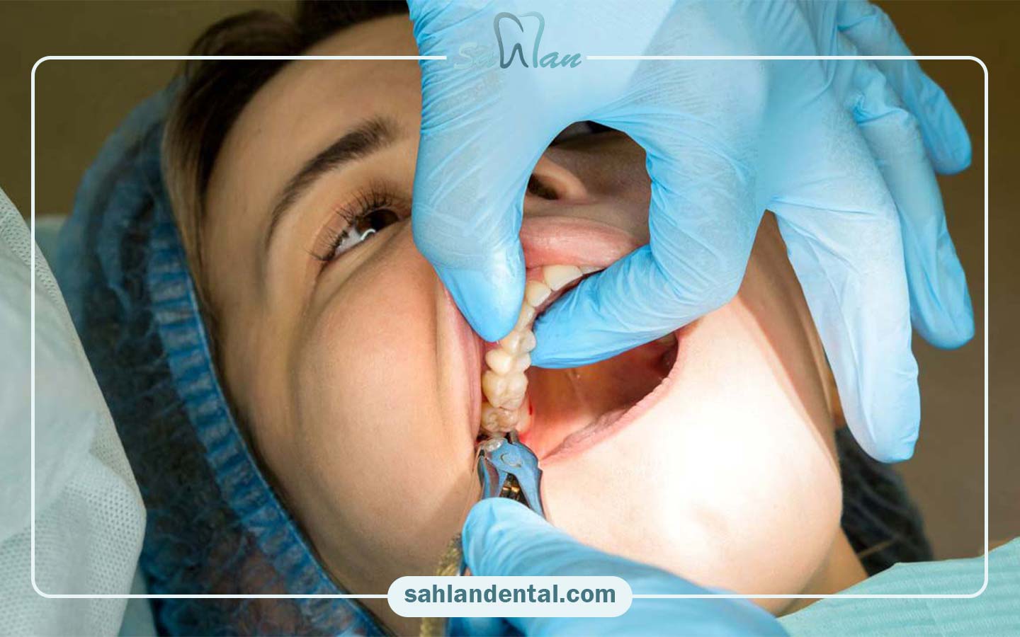 مزایای عصب‌کشی دندان عقل