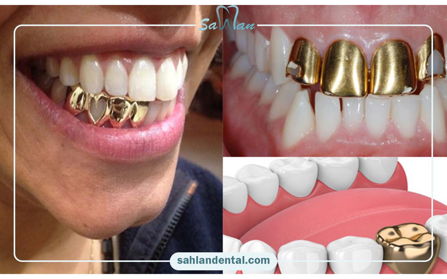 معایب روکش دندان