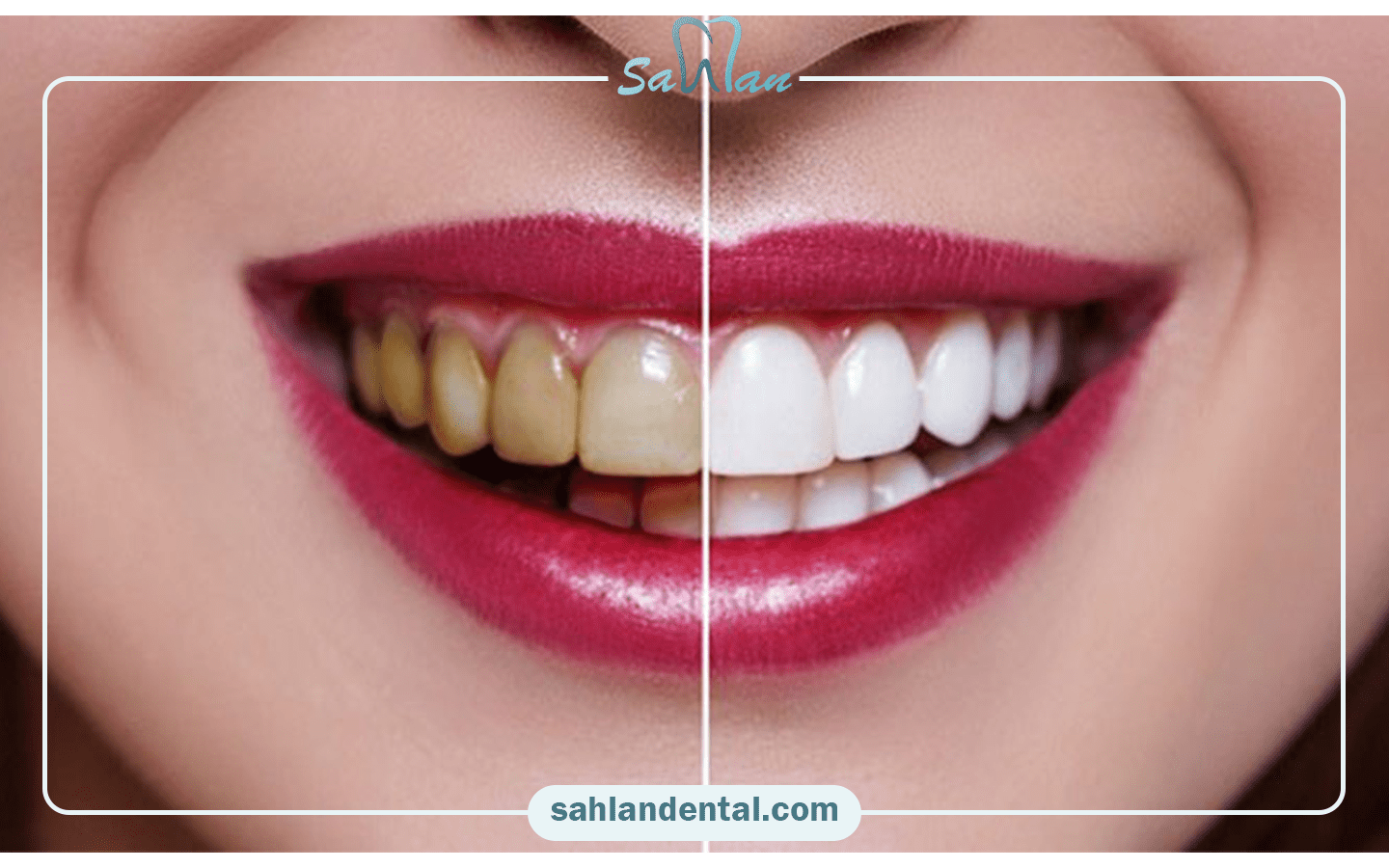 نقش فلوراید و محصولات دندانپزشکی در تغییر رنگ کامپوزیت دندان