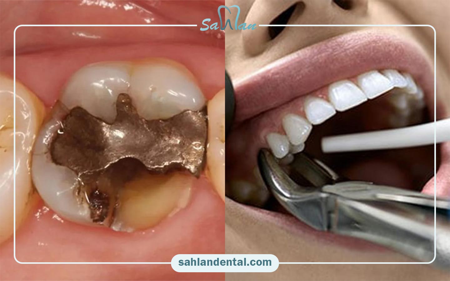 نکات مهم بعد از درمان ریشه دندان و عصب کشی