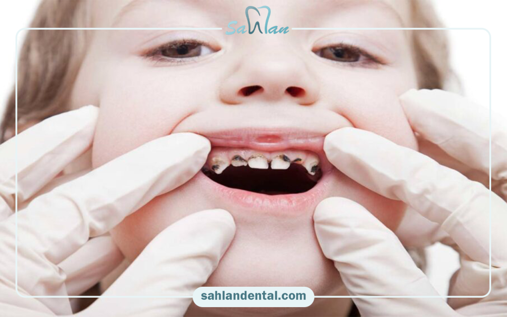 Broken or decayed teeth