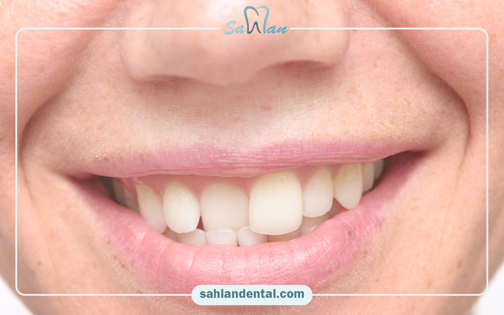Composite for crooked teeth