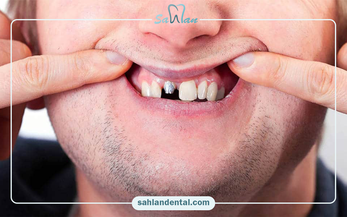 Composite tooth decay