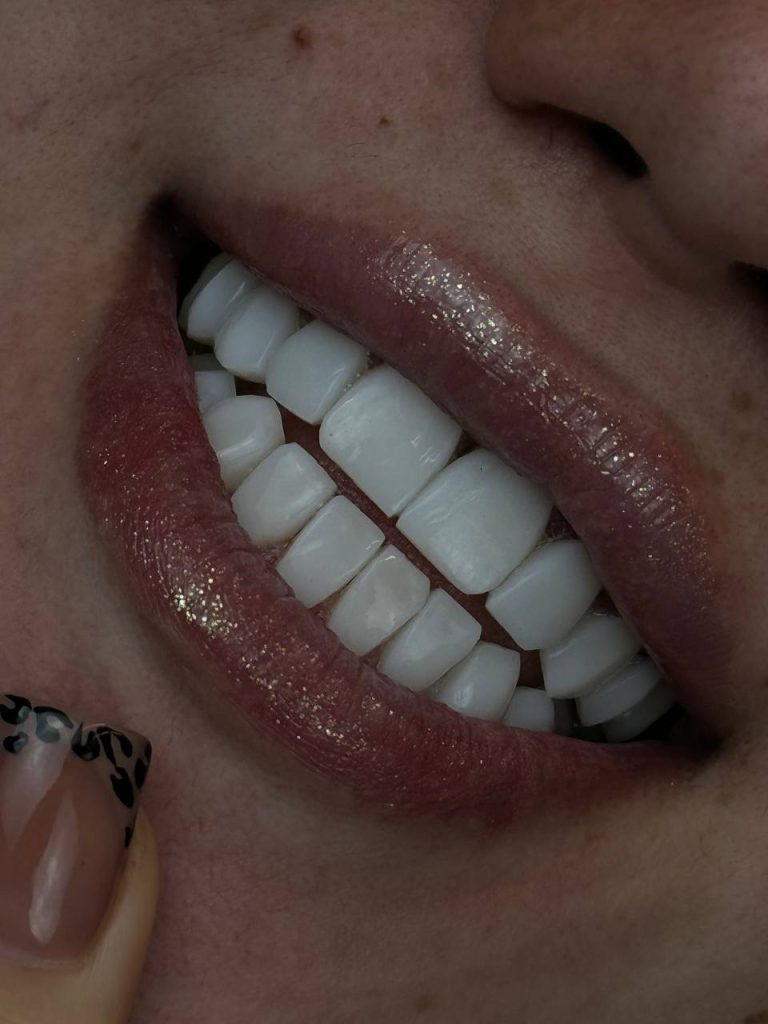 Does dental composite require a special toothbrush?