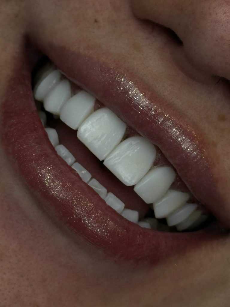 Does dental composite require ongoing restoration?