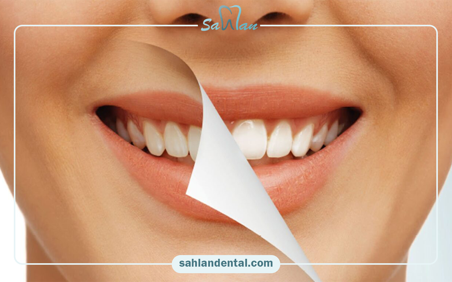 How long does the pain from composite veneers last?