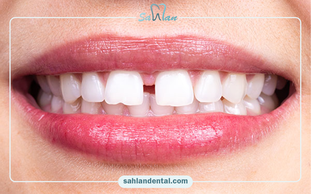 Restoration of front teeth