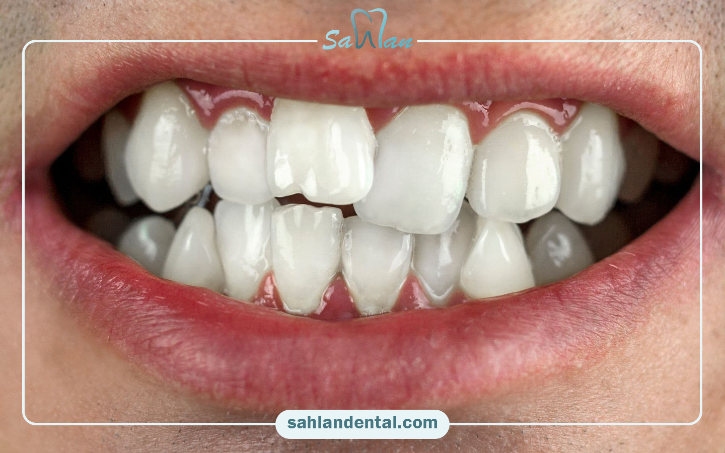 The advantage of correcting crooked teeth with composite