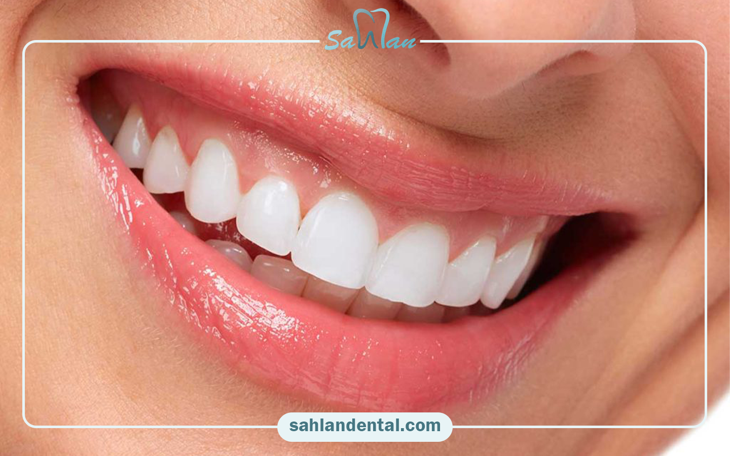 The difference between composite and dental veneers