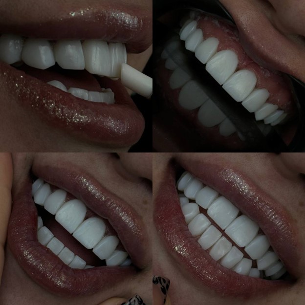 What care should be taken after composite?