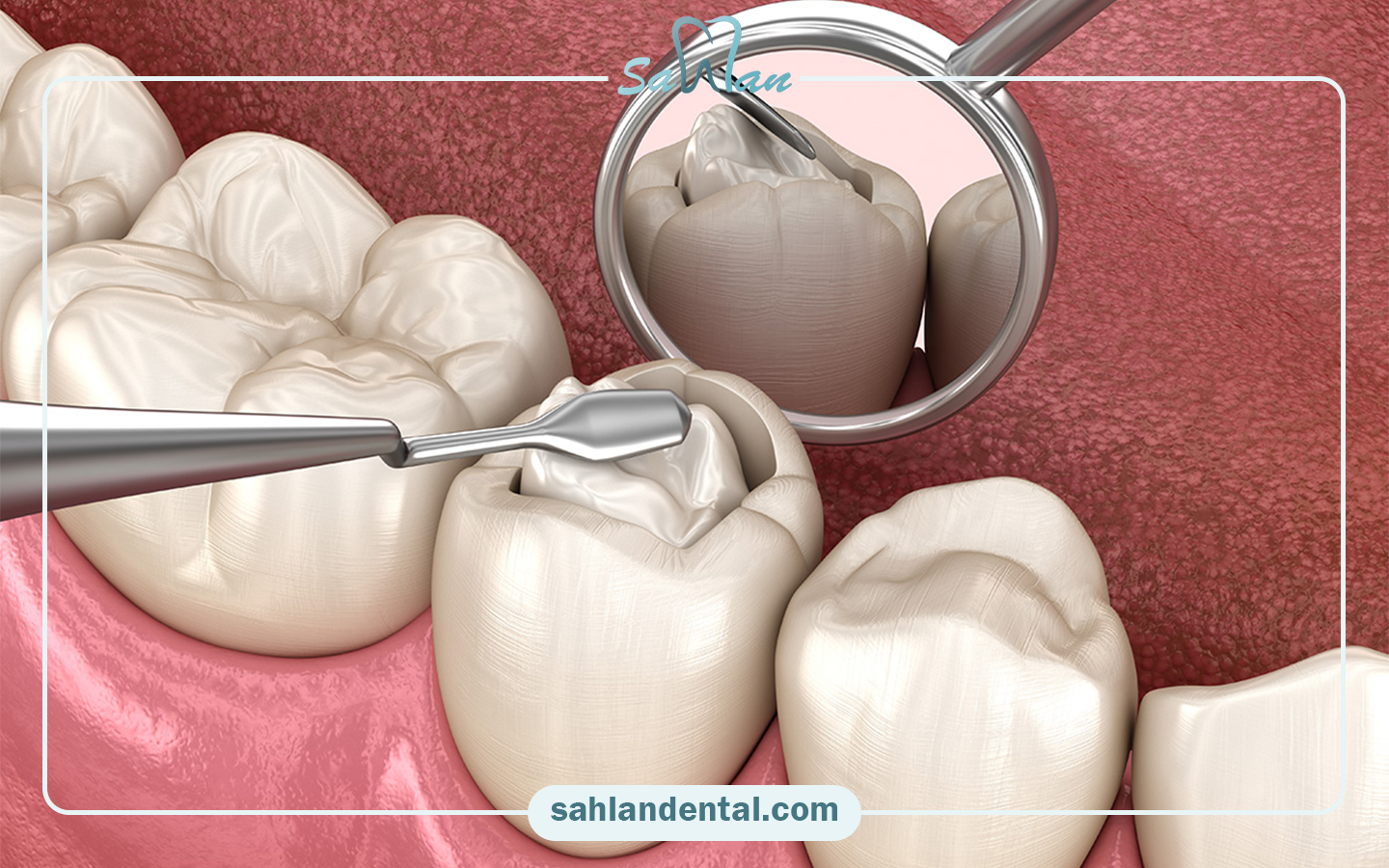 What should be done before composite?