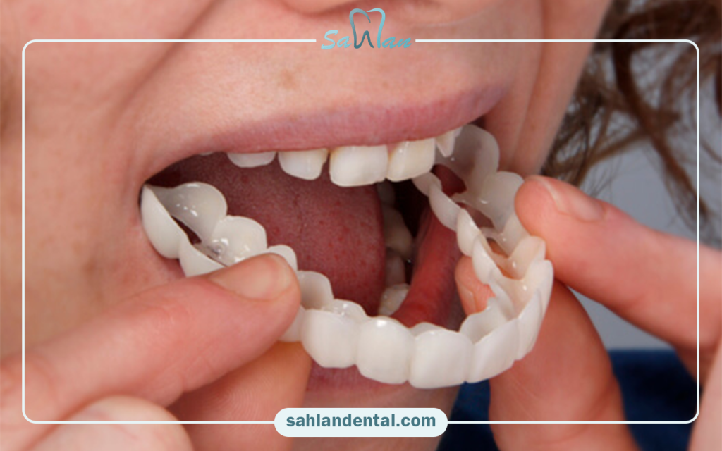 مزایا و معایب کامپوزیت متحرک دندان