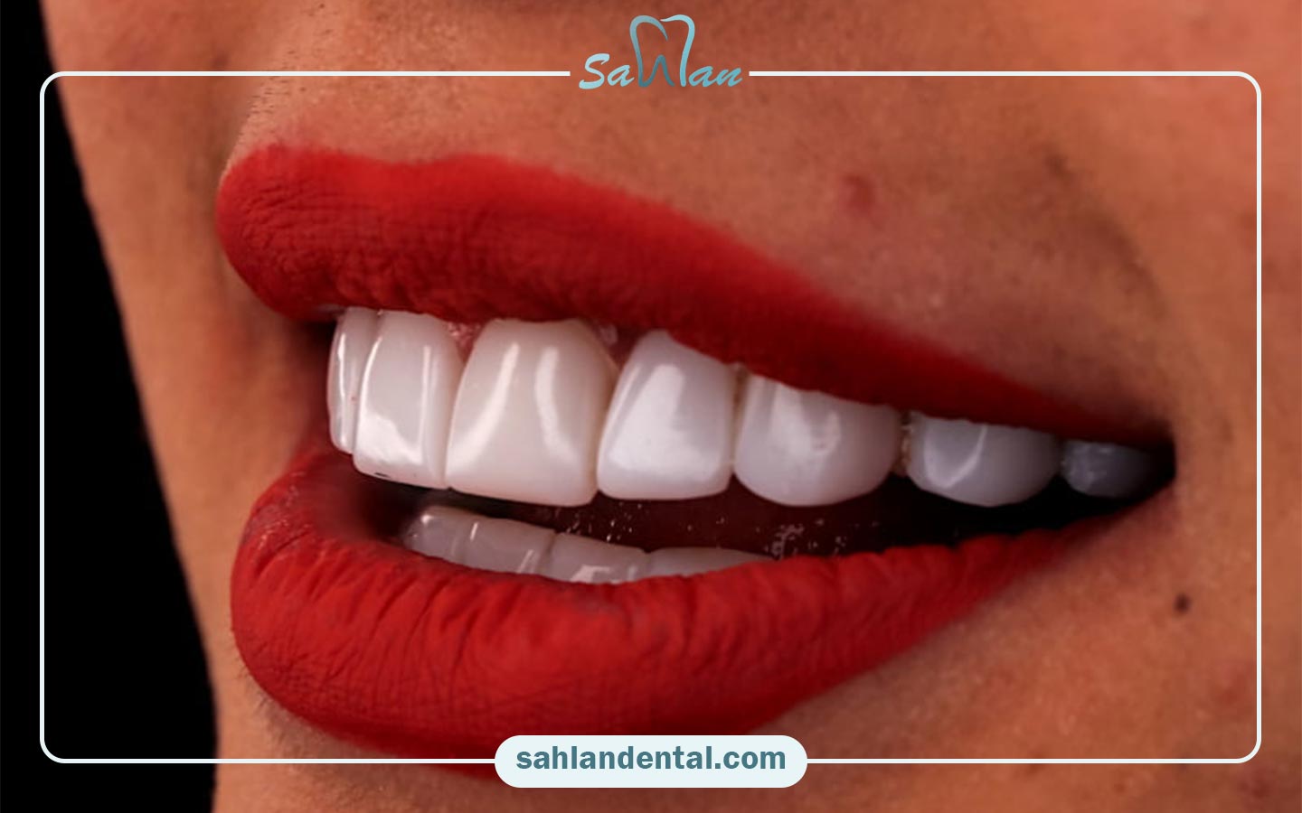 مراقبت بعد از ریمو کامپوزیت