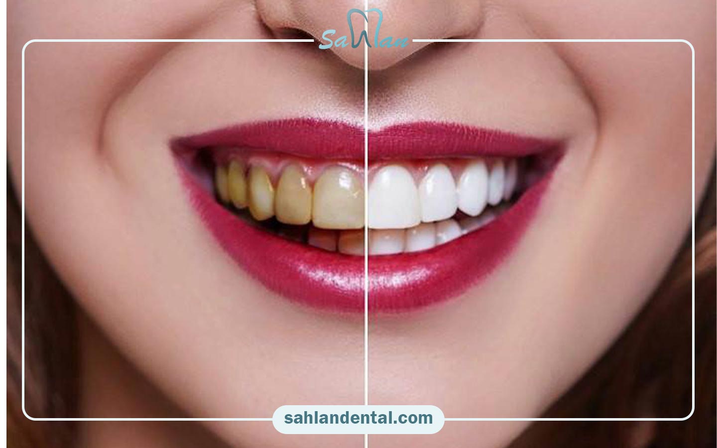 چه زمانی به ریمو کامپوزیت نیاز داریم