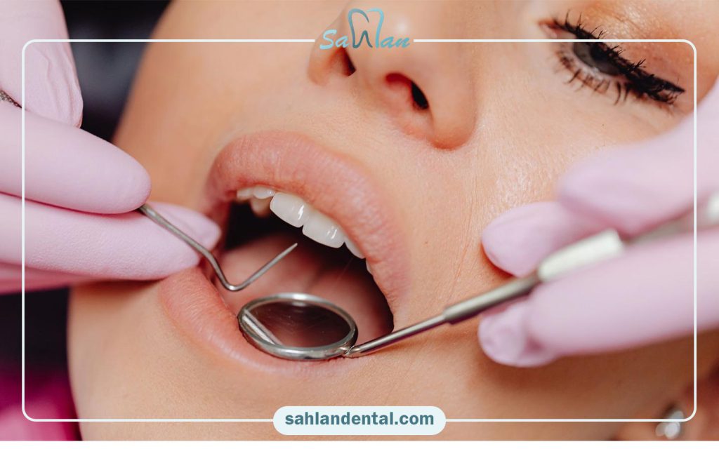 کامپوزیت اقساطی در کاشان