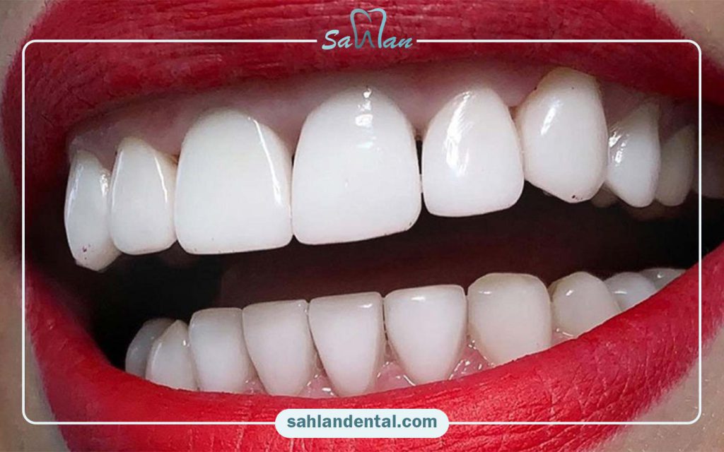 مشکلات لمینت دندان