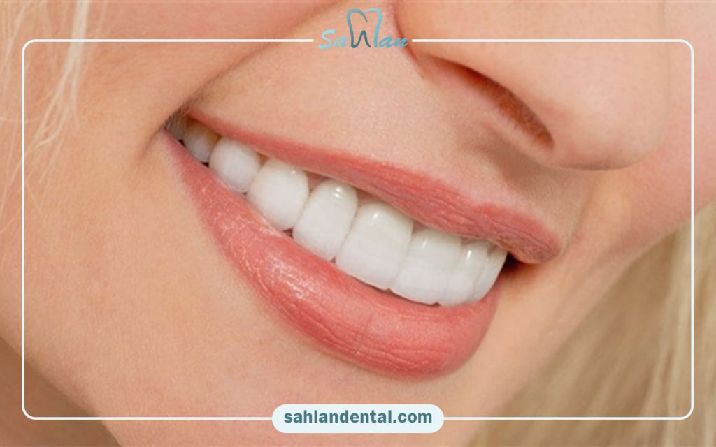 مهم‌ترین نکات مراقبت اولیه لمینت