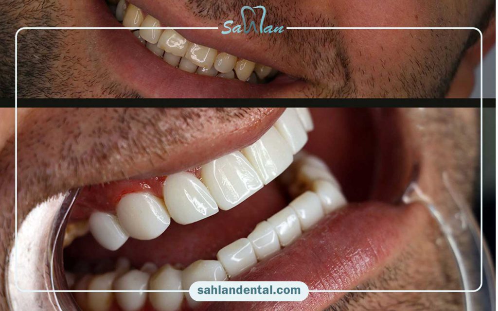 چه زمانی لمینت مناسب‌تر است و چه زمانی باید روکش انتخاب کرد