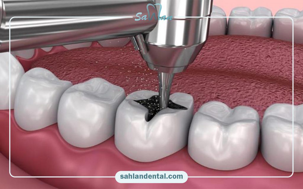 ترمیم دندان با بیمه ما(کارکنان بانک ملت) در تهران