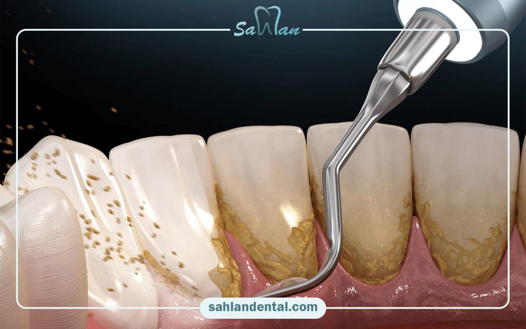 جرم گیری با بیمه ما(کارکنان بانک ملت) در تهران