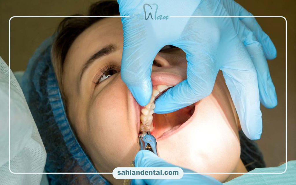 عصب کشی (درمان ریشه) با بیمه ما