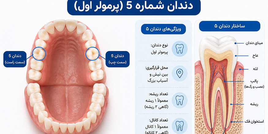 آیا همه دندان‌های شماره ۵ به روکش نیاز دارند