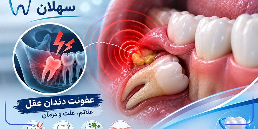 مهم‌ترین دلایل عفونت های دندان عقل