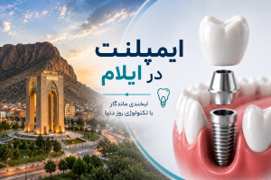 ایمپلنت در ایلام