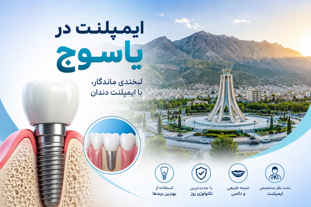 ایمپلنت در یاسوج| قیمت، مزایا و نحوه انتخاب متخصص