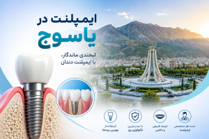 ایمپلنت در یاسوج| قیمت، مزایا و نحوه انتخاب متخصص